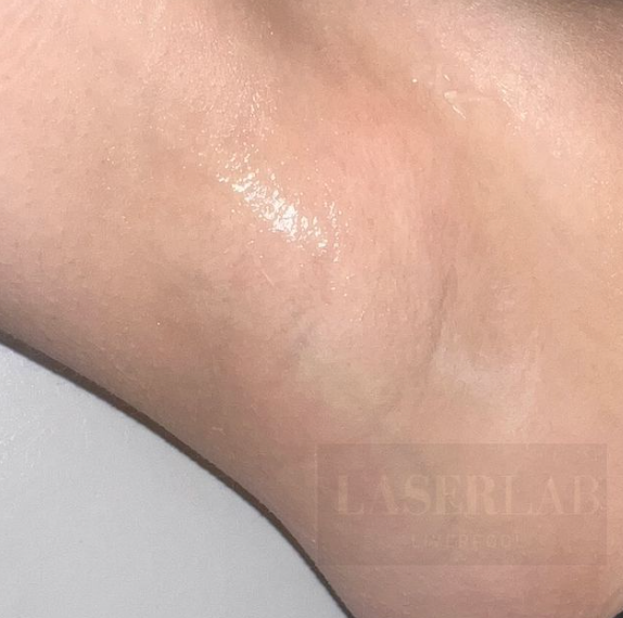 Laser Hair Removal Armpit After