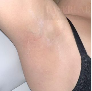 Laser Hair Removal Armpit After