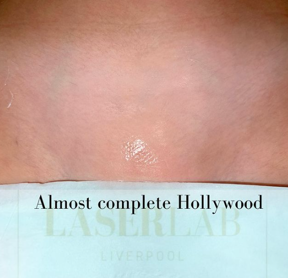 Laser Hair Removal Hollywood After