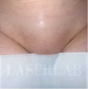 Laser Hair Removal Hollywood After