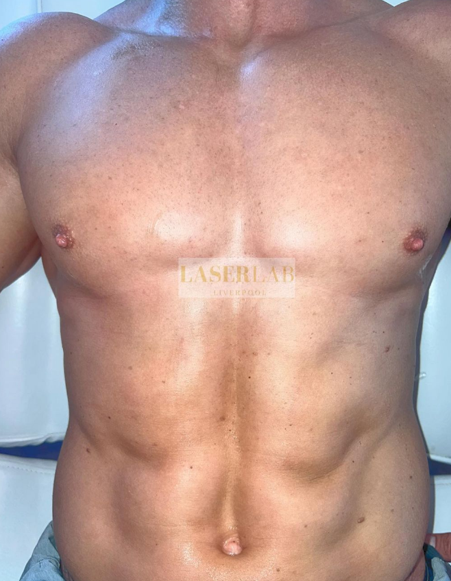Male chest / stomach after laser hair reduction